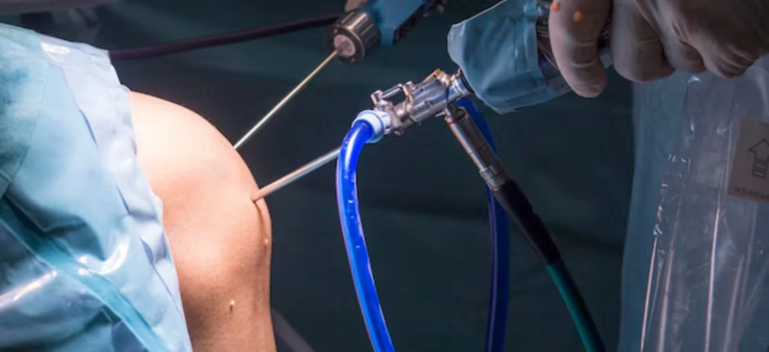 Knee Arthroscopy