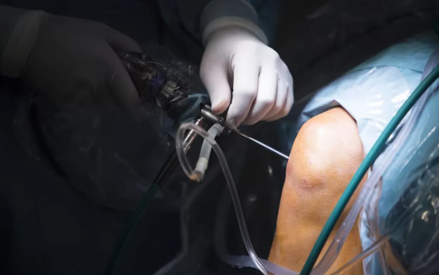Knee Arthroscopy