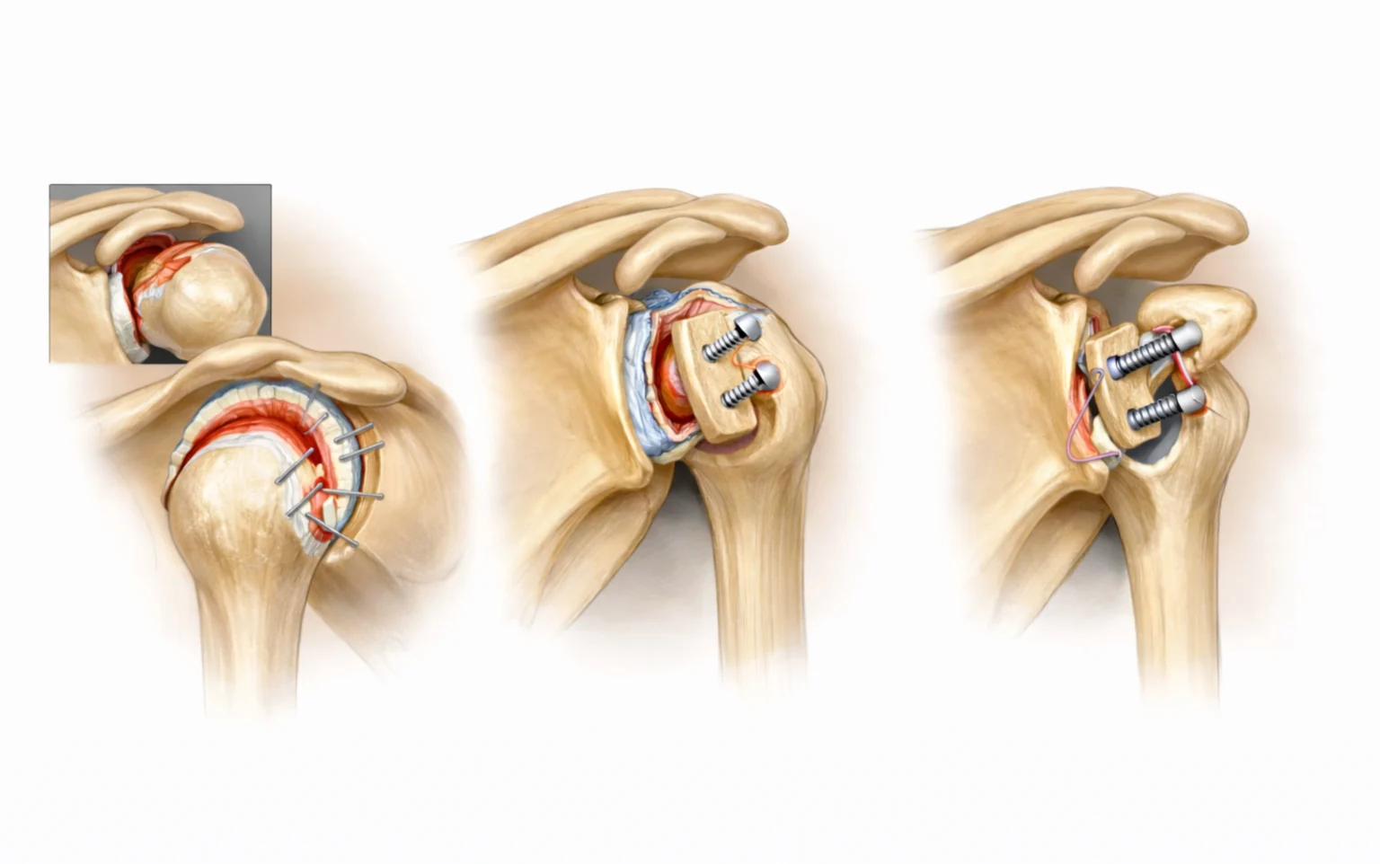 Shoulder Instability (Dislocation) Surgery